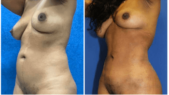 before and after